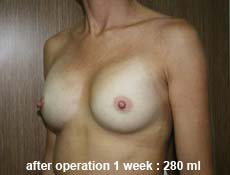 plastic-surgery-breast-augmentation 
